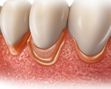 Receding Gums: Excellent Home Remedies