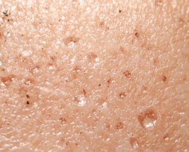 How to Get Rid of Blackheads Fast? Causes, Prevention, and Myths