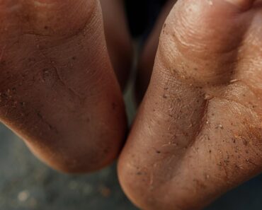 Calluses: 6 Powerful Home Remedies