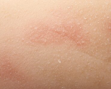 Burns: The Greatest Home Remedies