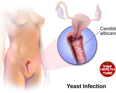 Yeast Infection: 6 Effective Natural Home Remedies