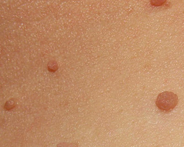 All You Need To Know About Skin Tags – Causes, Removal, Remedies And Prevention