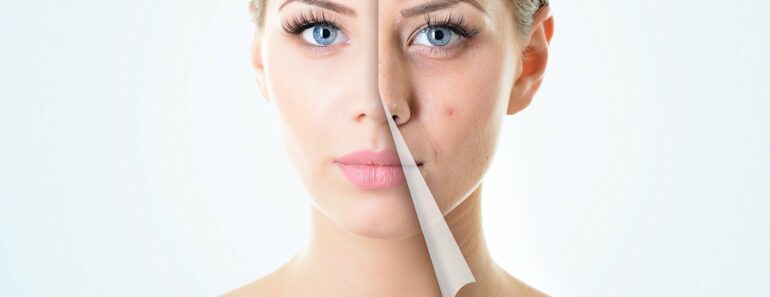 Say Goodbye to Breakouts: 9 Natural Hormonal Acne Fixes That Actually Work