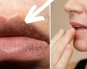 Doctors Claim ‘Silent Killer’ Condition Could Be Spotted by a ‘Strange’ Symptom on Your Lips