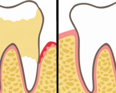 Dentists Explain 7 Habits That Can Ruin Your Teeth and Gums (And How to Fix It)