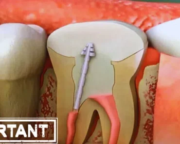 Emerging Research: How Root Canal Procedures May Increase Your Risk of Chronic Disease