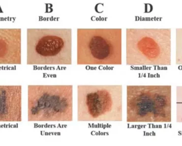 How To Recognize Skin Cancer – This Could Save Your Life!