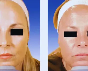 Identical Twins Share Startling Results After One Used Botox for 20 Years While the Other Didn’t