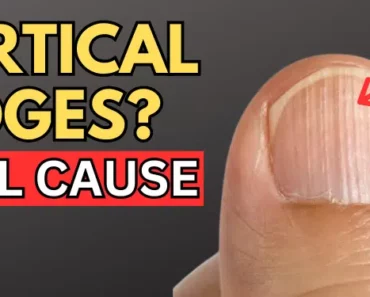 That’s The REAL Cause of VERTICAL RIDGES On Your Nails