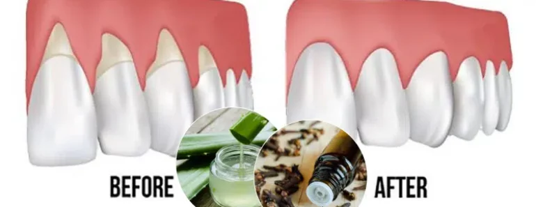 Grow Back Your Receding Gums With These Remedies