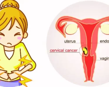 Most Women Miss These 3 Early Signs of Cervical Cancer