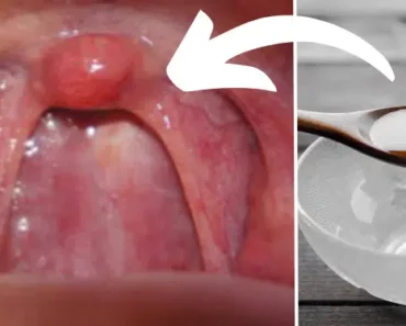 They Couldn’t Figure Out Why Her Breath Was So Bad, Until Her Doctor Found THIS!