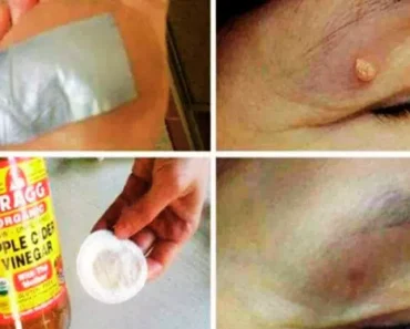 Eliminate Warts, Dark Spots, Blackheads, and Skin Tags Quickly and Effectively with These Easy Remedies