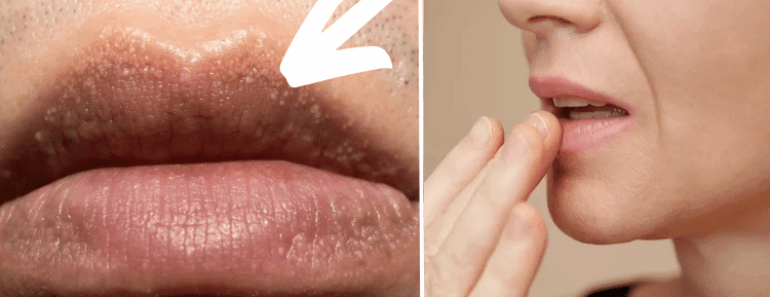 Doctors Claim ‘Silent Killer’ Condition Could Be Spotted by a ‘Strange’ Symptom on Your Lips