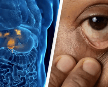 Little-Known Form of Cancer Surges in Young People—and There’s One Alarming Reason Why