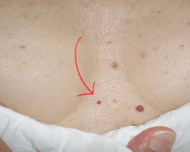 Do You Have These Red Spots on Various Parts of Your Body? Should You Worry? What Should You Do?
