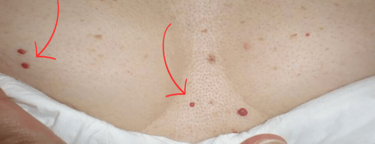 Do You Have These Red Spots on Various Parts of Your Body? Should You Worry? What Should You Do?