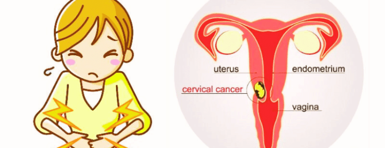 Most Women Miss These 3 Early Signs of Cervical Cancer