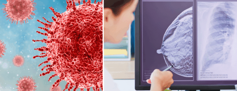 Primary Causes of Breast Cancer Need To Know
