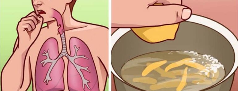 10 Home Remedies to Help With Bronchitis and Painful Coughing Attacks